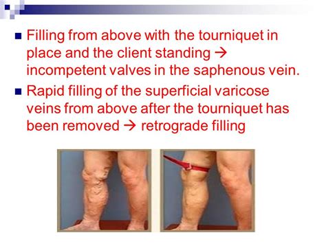 manual compression test veins|long saphenous vein examination.